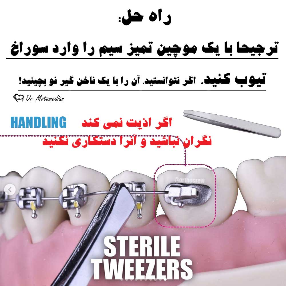 بیرون آمدن سیم از براکت ارتودنسی