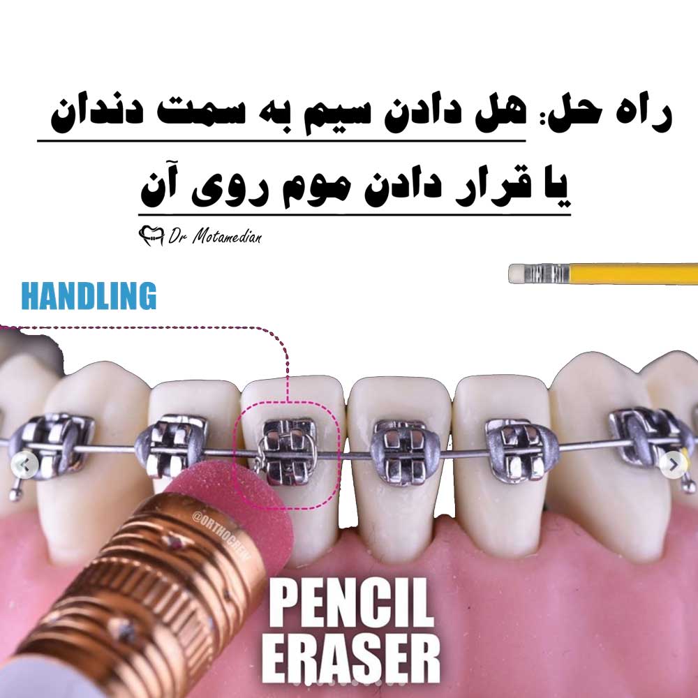 سیم نوک تیز بیرون زده ارتودنسی