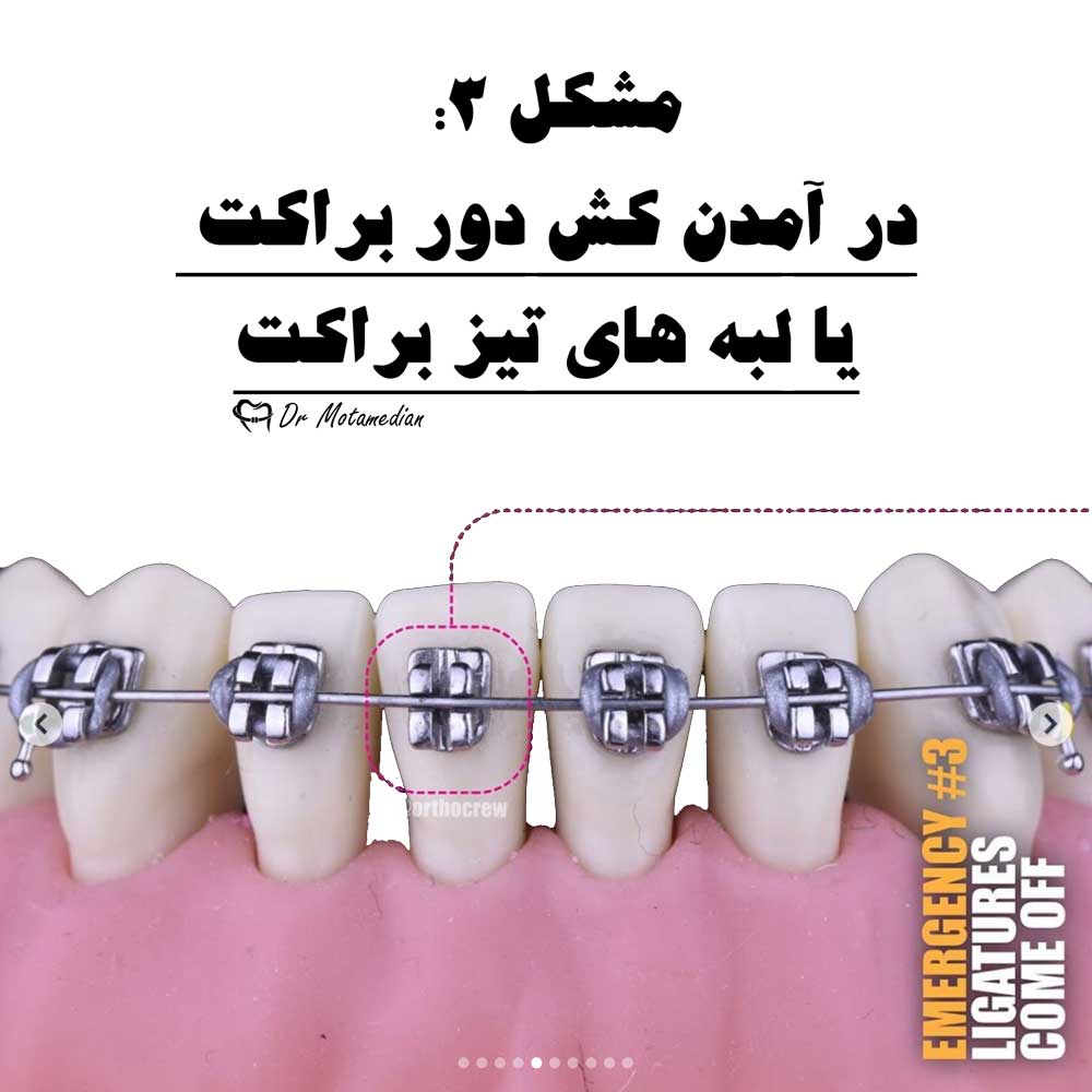 در آمدن کش دور براکت