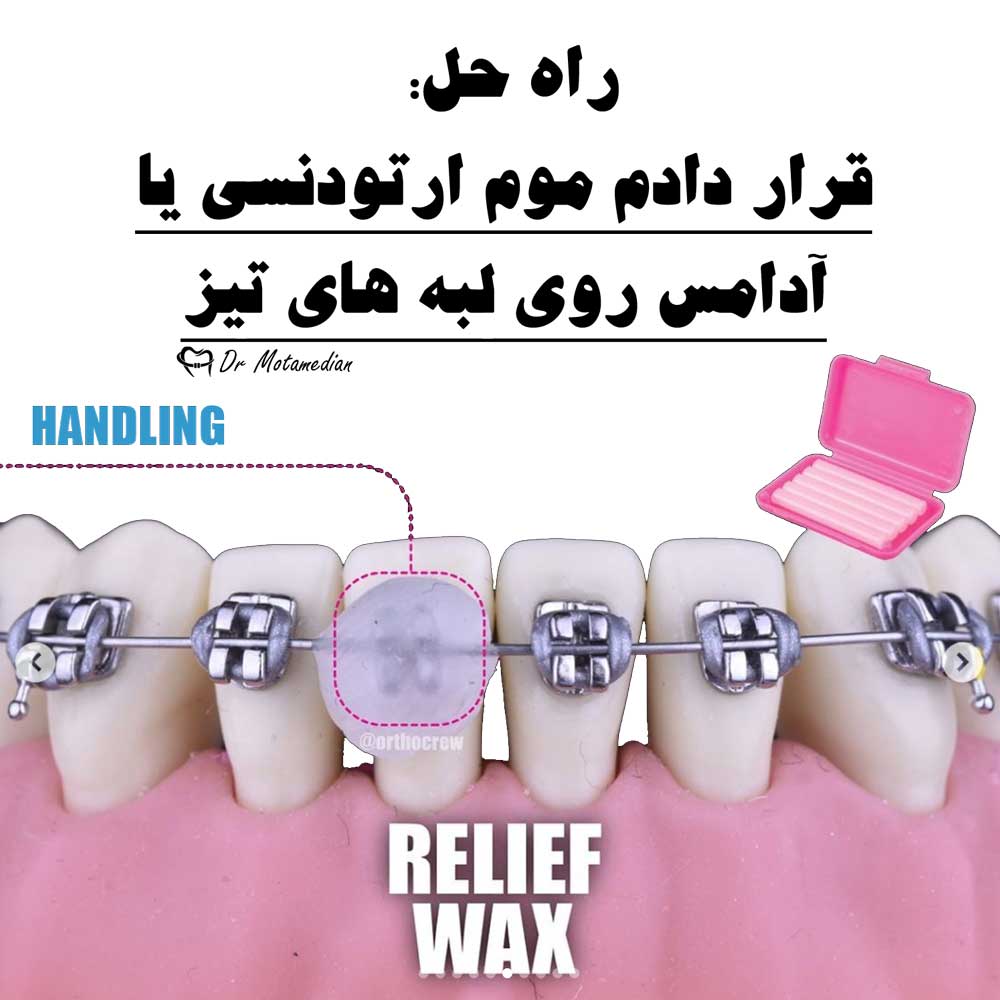 در آمدن کش دور براکت