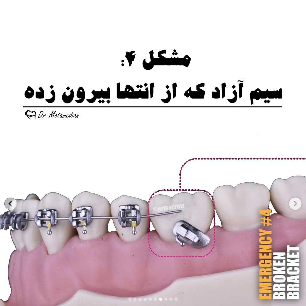 سیم بیرون زده ارتودنسی
