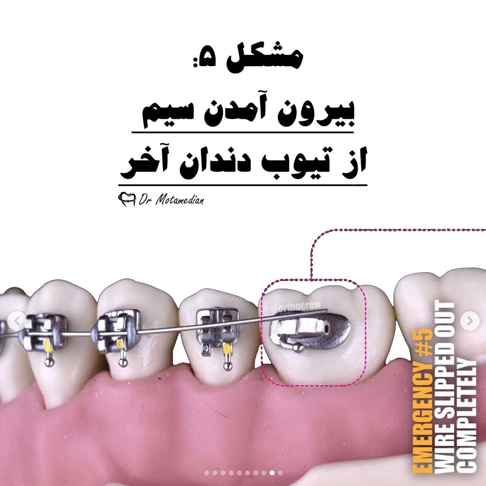 بیرون آمدن سیم از براکت ارتودنسی